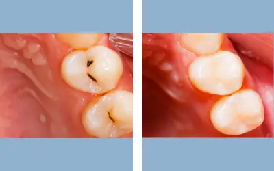 Before and After
